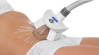 Cryolipolyse behandeling (1 zone)